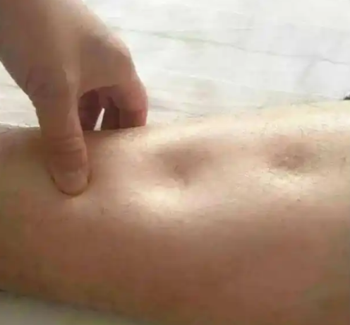 붓기와 혈압의 관계, 체내 수분 균형으로 건강 지키기